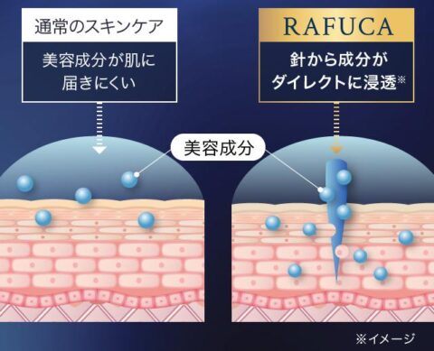 天然 マイクロニードル スピキュール