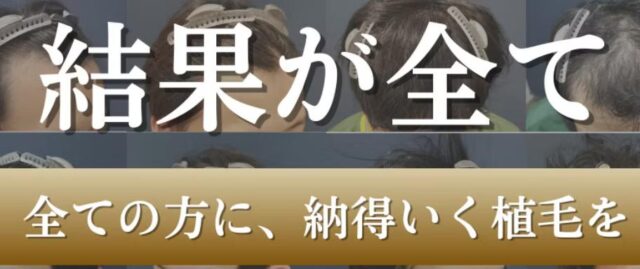 アルモ形成クリニック 自毛植毛 特徴
